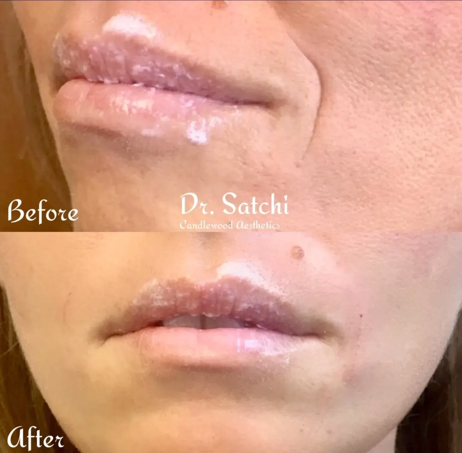 Comparison of lips before and after treatment, showing improvement in lip hydration and appearance.