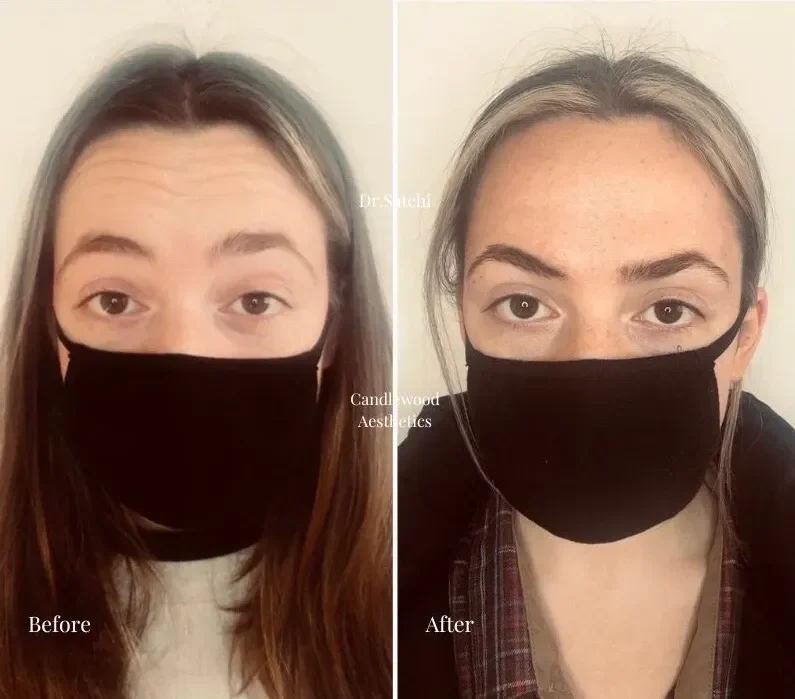 Side-by-side comparison of a woman's face before and after cosmetic treatments. In the before image, the woman has a smooth face with some wrinkles visible around the eyes. In the after image, her skin appears more toned and youthful. She is wearing 