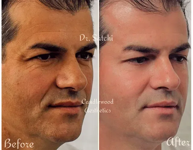 Comparison image showing a man's face before and after cosmetic treatment, with the left side labeled 'Before' and the right side labeled 'After.'