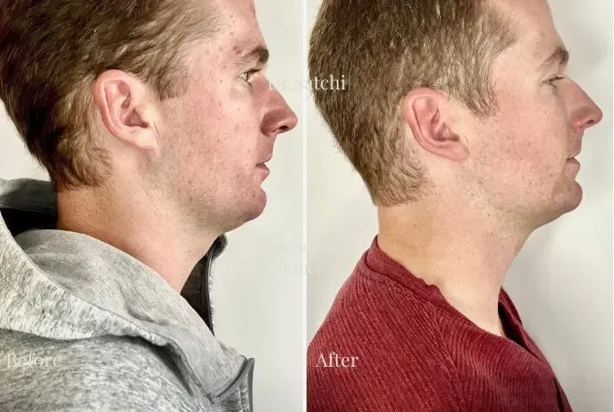 Side-by-side comparison of a young man before and after a haircut, showing hair growth and change in hairstyle.