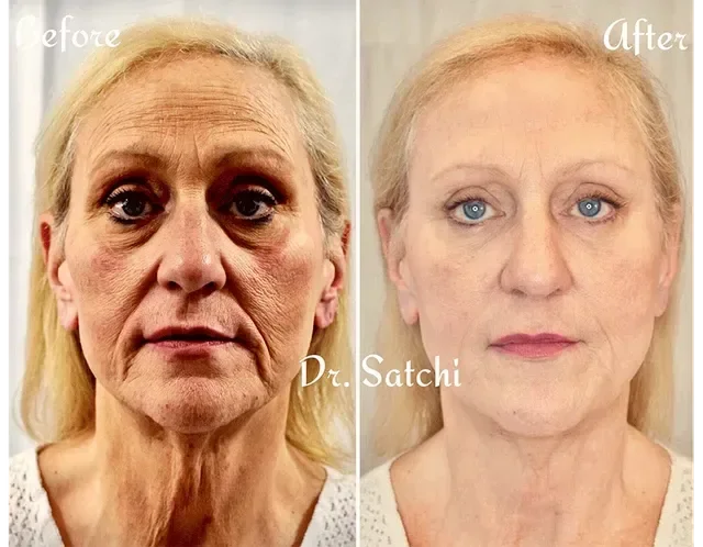 Side-by-side comparison of a woman's face showing before and after cosmetic treatment, with the 'before' on the left and 'after' on the right, both labeled. The woman has light skin and blonde hair.