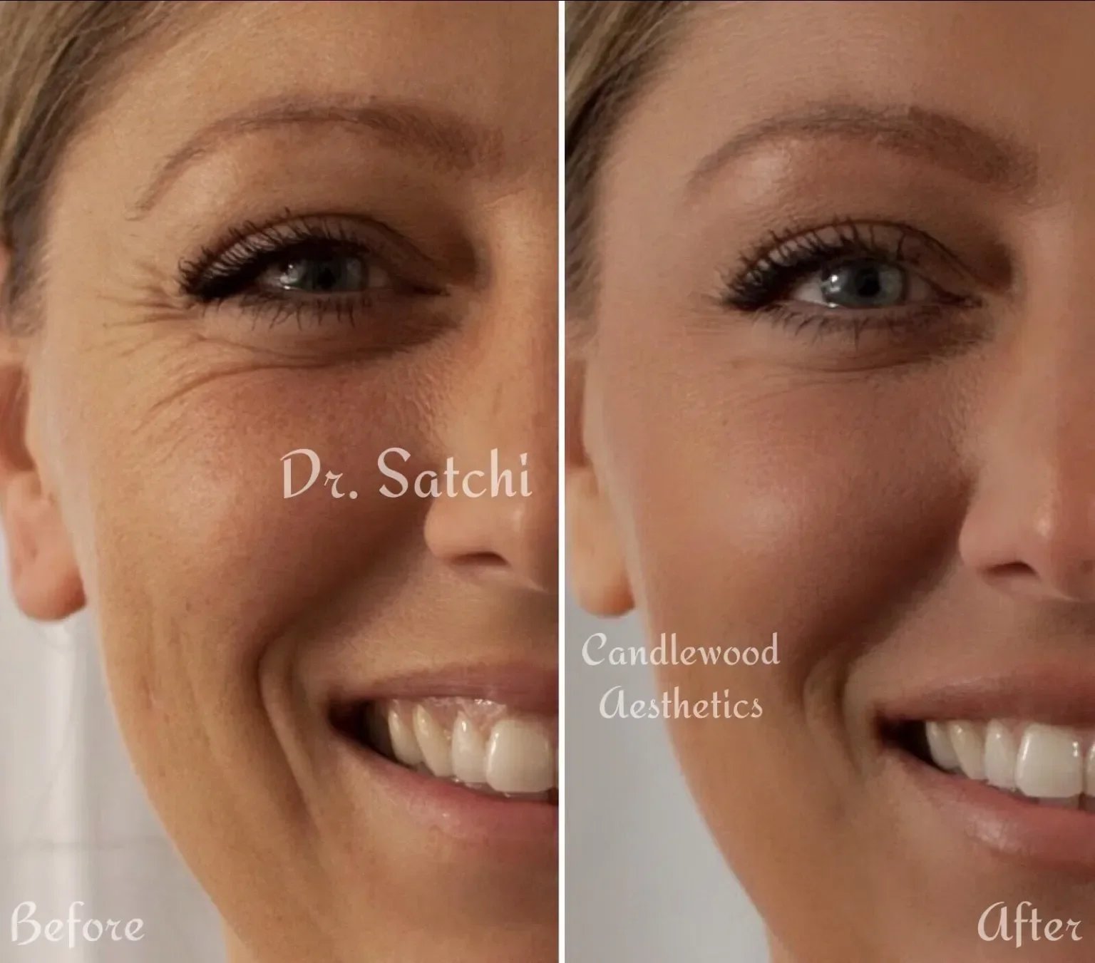 Side-by-side comparison of a woman's face before and after a cosmetic procedure, showing reduction in wrinkles around the eye and improved skin smoothness.