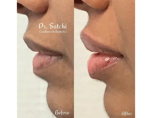 Side-by-side comparison of a person's lower face showing a before and after image of lip augmentation. The before image shows natural lips, while the after image shows fuller, plumper lips.