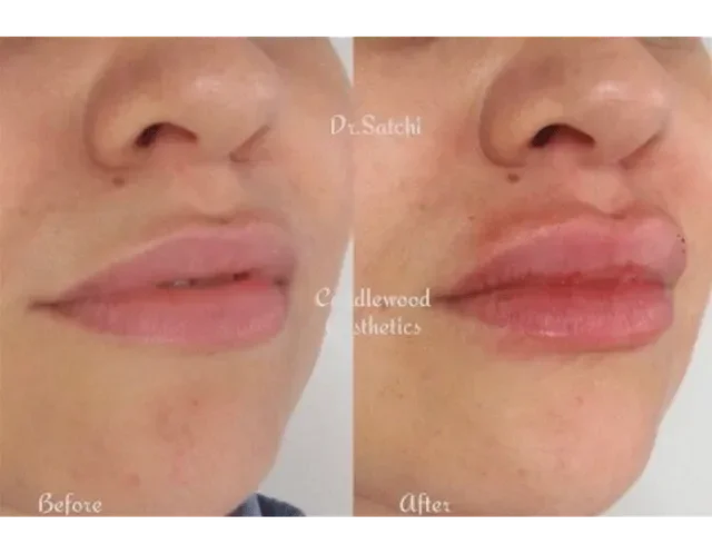 Close-up comparison of a person's lips before and after cosmetic treatment, showing fuller lips and improved lip contour in the after image.
