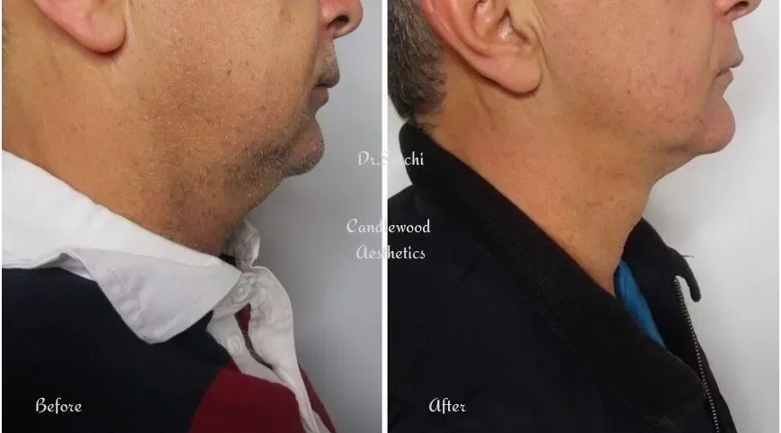 Side-by-side comparison of a man's neck and jawline before and after cosmetic treatment, showing a reduction in double chin.