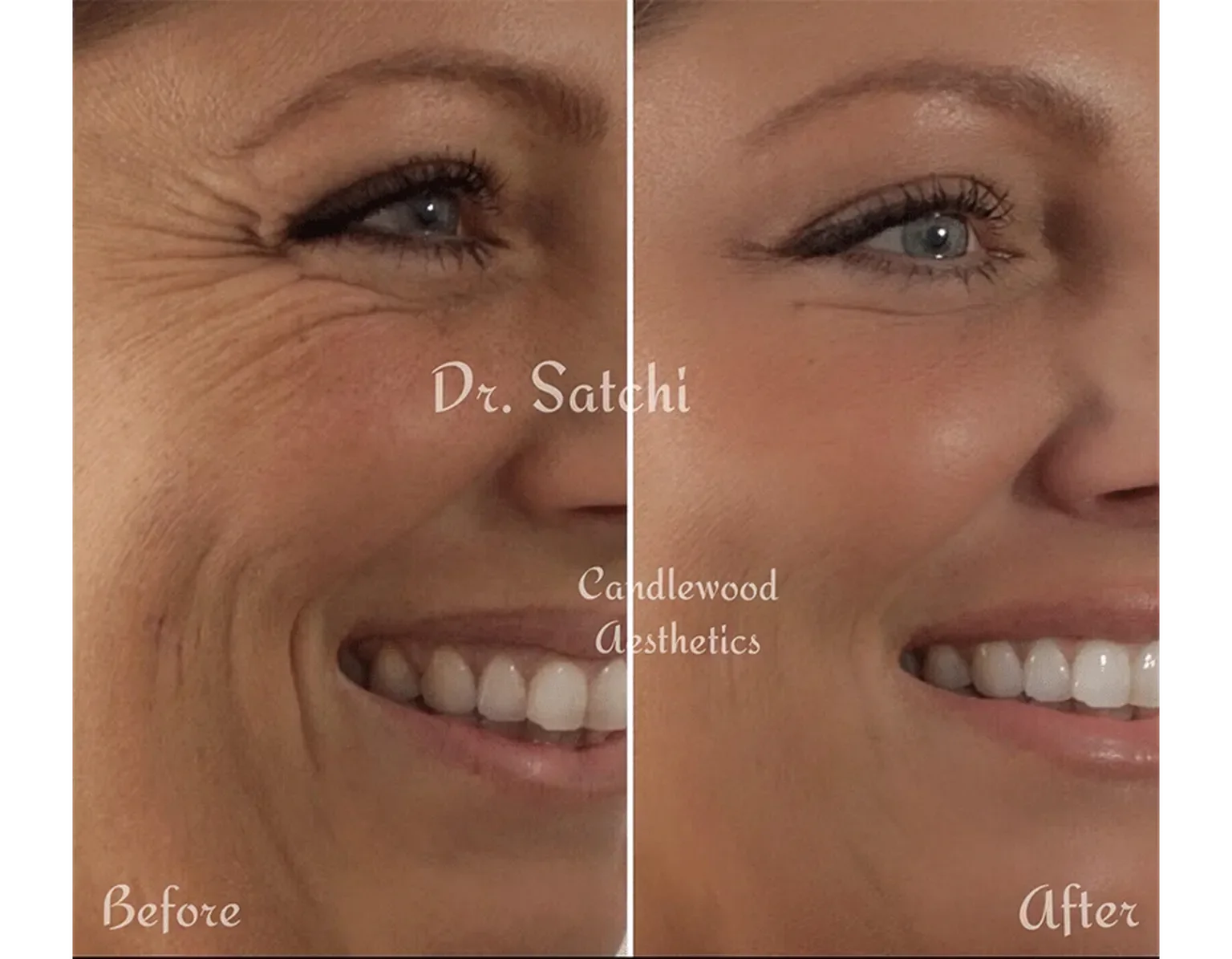 Before and after comparison photo of a woman's face showing wrinkle reduction, with Dr. Satchi Candlewood Aesthetics written in the center.
