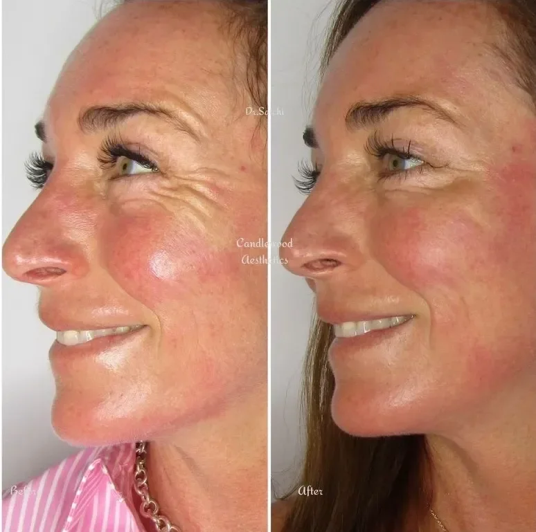 Side-by-side comparison of a woman's face showing before and after skin treatment. The left image is the 'before' with more pronounced wrinkles around the eye and cheek, while the right image is the 'after' with smoother skin and fewer wrinkles.