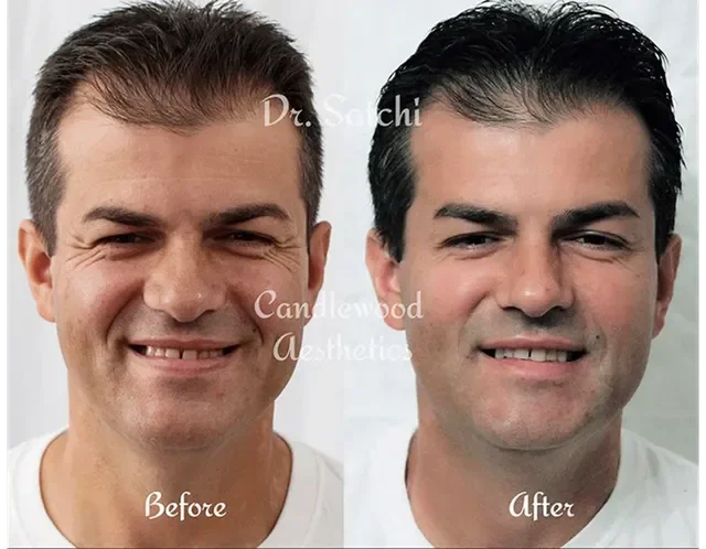 Side-by-side comparison of a smiling man before and after cosmetic procedure, with the words "Before" and "After."