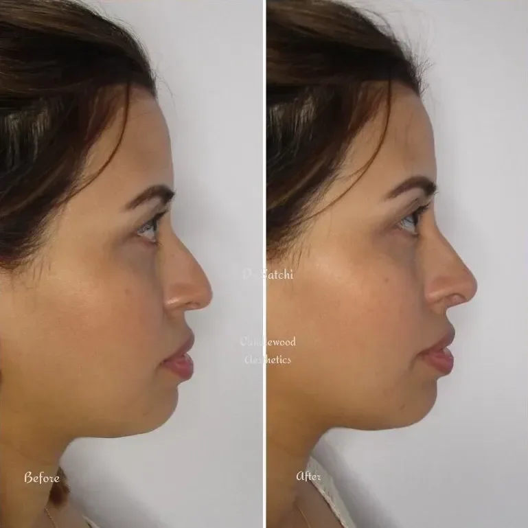 Side-by-side comparison of a woman's face before and after a cosmetic procedure, showing changes in the shape of her nose.