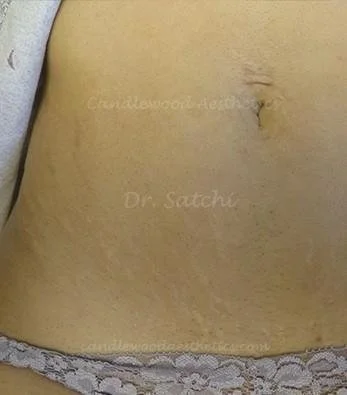 Close-up of a person's lower abdomen showing a surgical scar and faint markings.