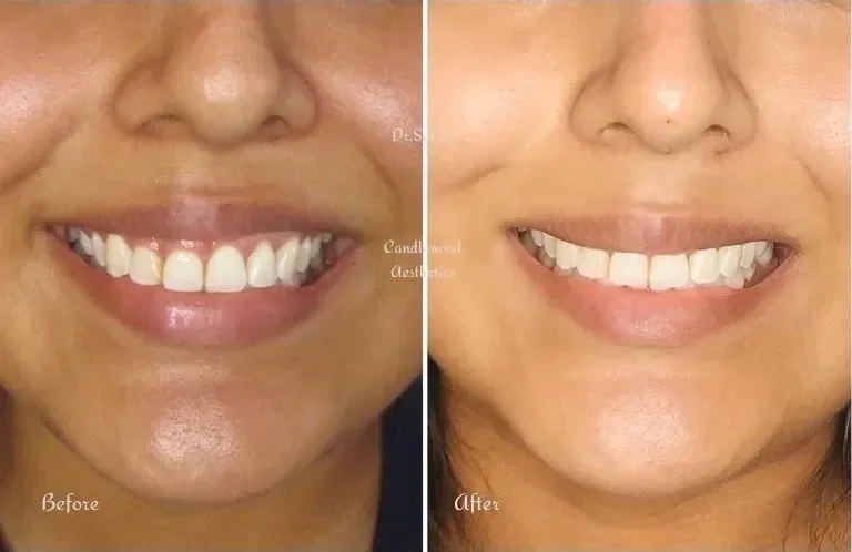 Comparison of a person's smile before and after dental treatment showing whiter, straighter teeth.