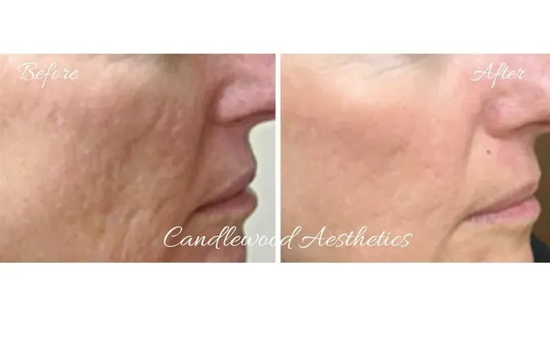 Side-by-side comparison of skin before and after treatment, showing improved skin texture and reduced wrinkles.
