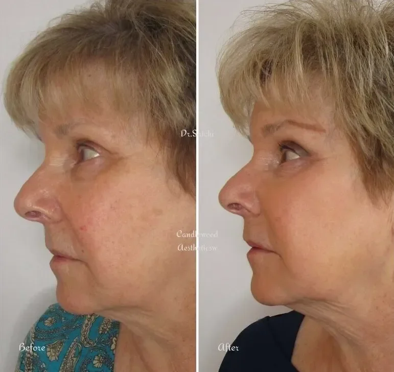 Side-by-side comparison of a woman's face showing before and after cosmetic treatment. The left side shows her skin with visible blemishes and uneven tone, while the right side shows smoother, clearer skin with a more youthful appearance.