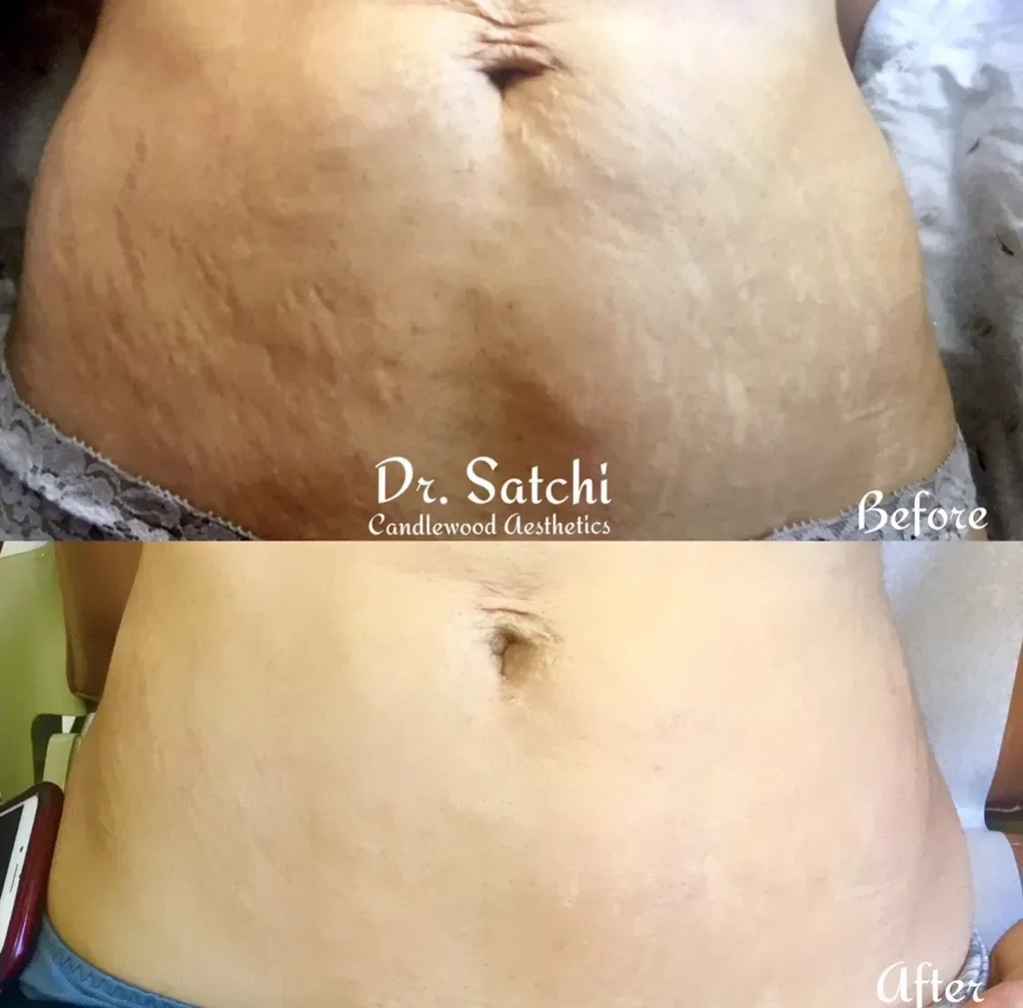 Before and after comparison of a person's abdomen showing reduction in stretch marks after treatment by Dr. Satchi at Candlewood Aesthetics.