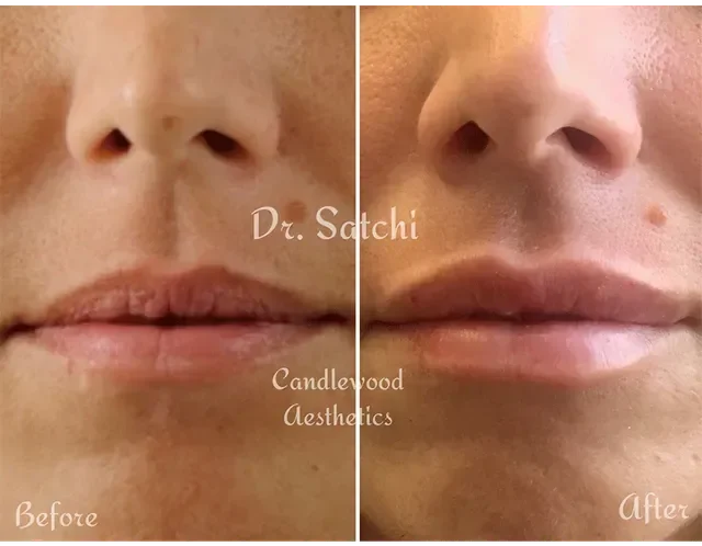 Close-up of a person's nose and mouth showing before and after results of a cosmetic procedure, with the caption 'Dr. Satchi Candlewood Aesthetics'.