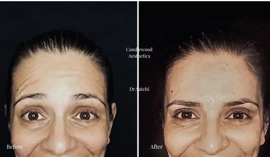 Side-by-side comparison of a woman's face, showing a 'before' image on the left with noticeable wrinkles and uneven skin and an 'after' image on the right with smoother skin and fewer wrinkles, with text indicating skincare brands and dermatologist.