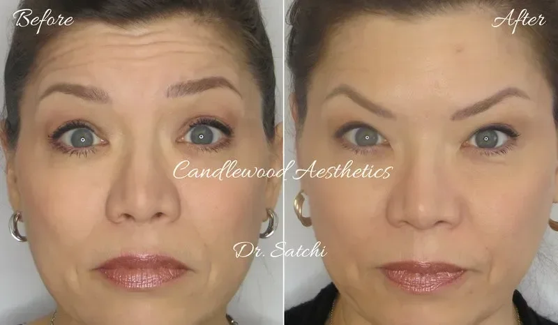 Side-by-side comparison of a woman's face before and after cosmetic treatment, showing smoother skin and more defined facial features.