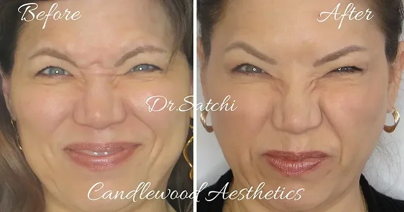 Before and after images showing a woman with improved skin appearance after treatment by Dr. Satchi at Candlewood Aesthetics.