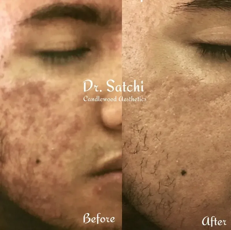 Close-up of a person's face showing a before and after comparison of skin treatment. The left side labeled 'Before' shows skin with acne scars and pigmentation, while the right side labeled 'After' shows smoother skin with reduced scars and pigmentat