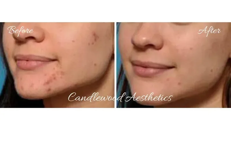 Side-by-side comparison of a person's face showing improvement in acne and skin clarity, labeled 'Before' and 'After' with text 'Candlewood Aesthetics'.