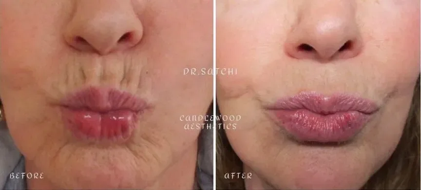 Side-by-side comparison of a woman's mouth showing before and after cosmetic lip treatment, with the before side displaying wrinkles and fine lines, and the after side showing fuller, smoother lips.