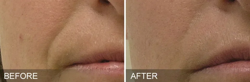 Close-up of a person's lips and lower face before and after skincare treatment, showing reduced redness and smoother skin.
