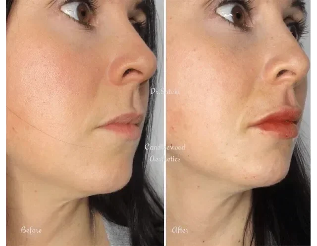 Side-by-side comparison of a woman's face showing before and after cosmetic or makeup application, with changes in skin tone and lipstick. The left image is labeled 'Before' and the right 'After.'