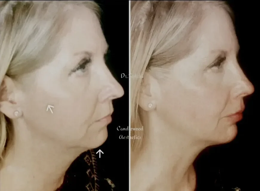 Side-by-side comparison of a woman's face before and after cosmetic treatment, showing reduced wrinkles and a more youthful appearance.