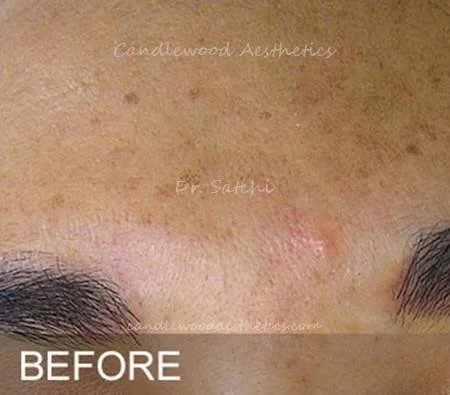 Close-up of a person's forehead showing acne scars and blemishes before skincare treatment.