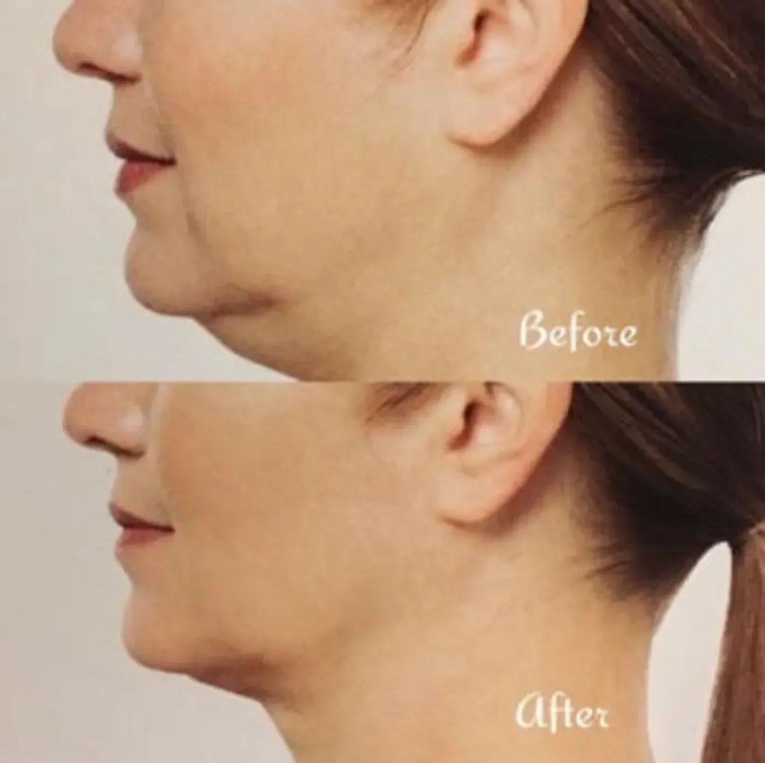 Comparison of a woman's profile before and after a cosmetic procedure, showing reduced double chin and smoother jawline in the after image.