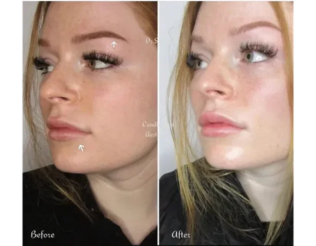 Side-by-side comparison of a woman's face showing before and after cosmetic enhancement, with labels 'Before' and 'After'.