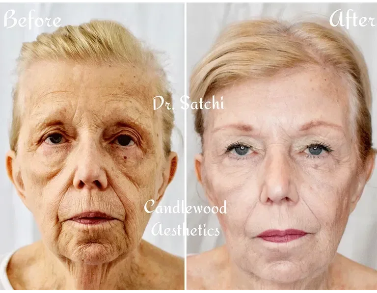 Side-by-side comparison of an elderly woman before and after cosmetic treatment, showing improved skin appearance