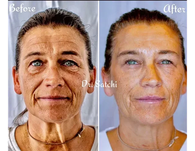 Side-by-side comparison of a woman before and after skincare treatment, showing reduced wrinkles and improved skin texture.