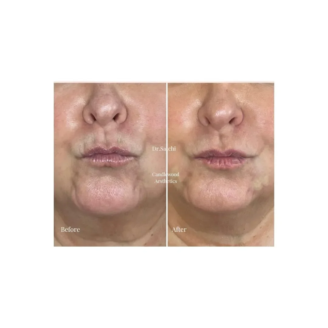 Comparison of a person's lower face before and after cosmetic treatment, showing improved skin texture and reduced signs of aging.