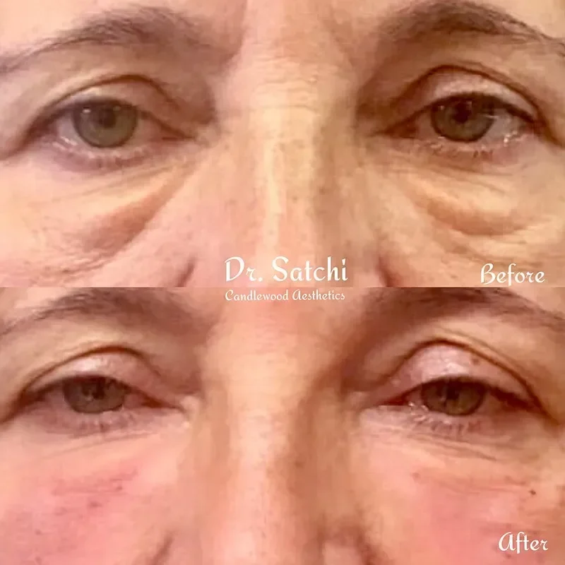 Close-up of a person's eye area showing a before and after comparison of cosmetic treatment by Dr. Satchi at Candlewood Aesthetics, with reduced puffiness and wrinkles in the after photo.