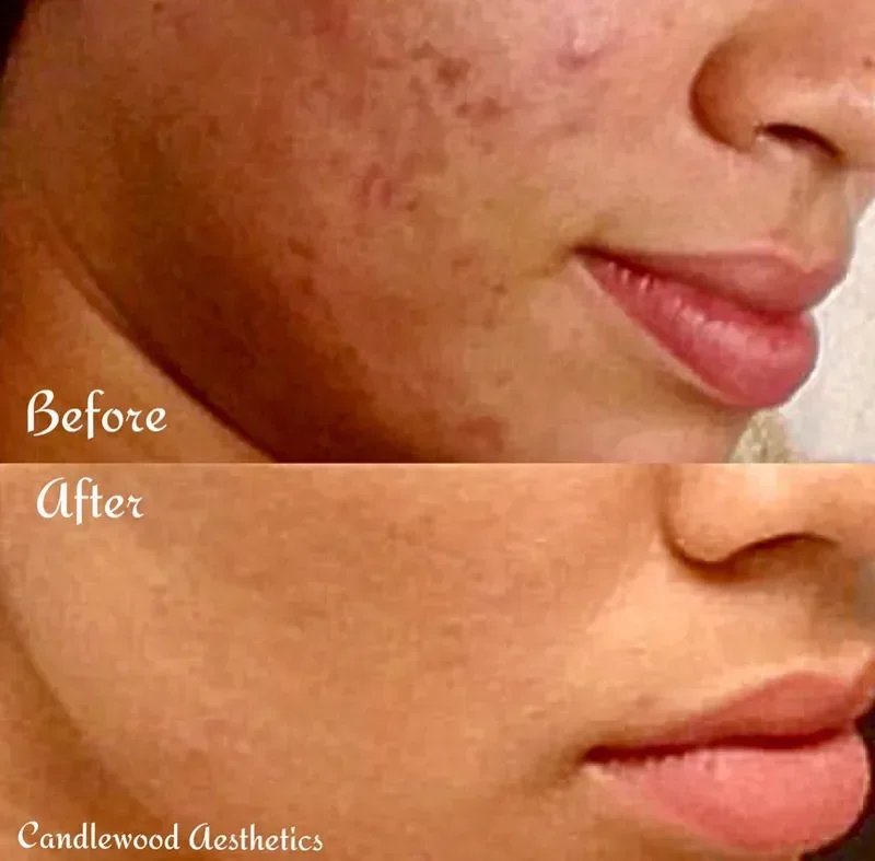 Comparison photo showing a person's face before and after skin treatment, highlighting clearer skin and reduced blemishes in the after image.