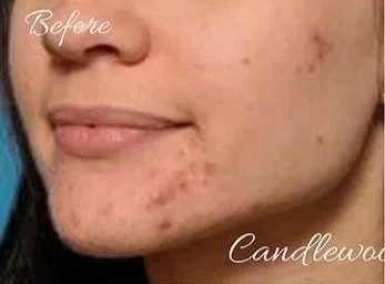 Close-up of a person's face showing skin with acne and scars, labeled 'Before' and 'Candlewax'.