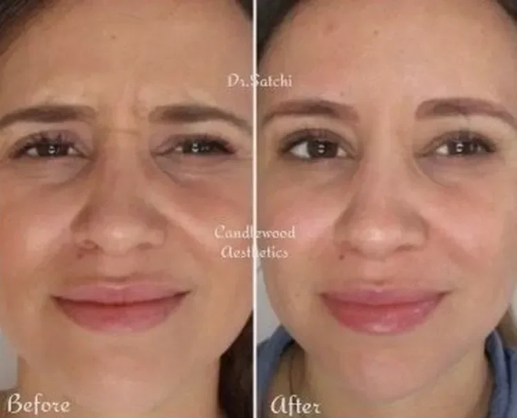 Before and after comparison of a woman's face showing reduced wrinkles and smoother skin, indicating a skincare or cosmetic treatment improvement.