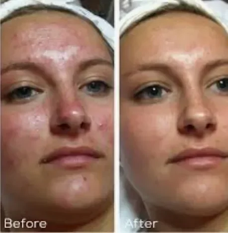 Side-by-side comparison of a woman's face showing skin improvement, with the left labeled 'Before' and the right labeled 'After'.