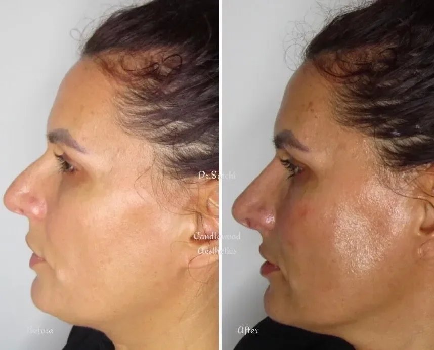 Side-by-side comparison of a woman's profile showing before and after facial treatments. The before image shows dull skin, while the after image displays smoother, more luminous skin with improved texture.