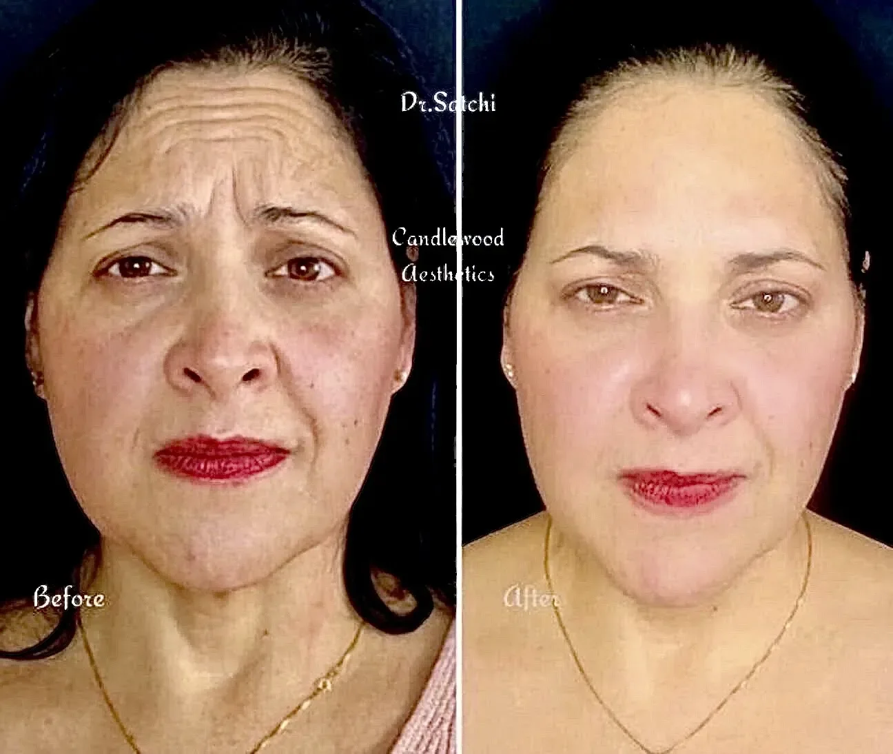 Side-by-side comparison of a woman's face before and after cosmetic treatment, showing reduced wrinkles and smoother skin.