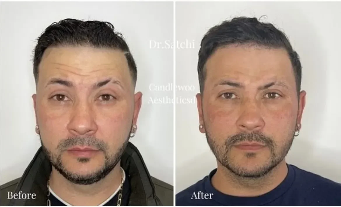 Side-by-side comparison of a man before and after a cosmetic procedure, showing improved skin texture and facial appearance.