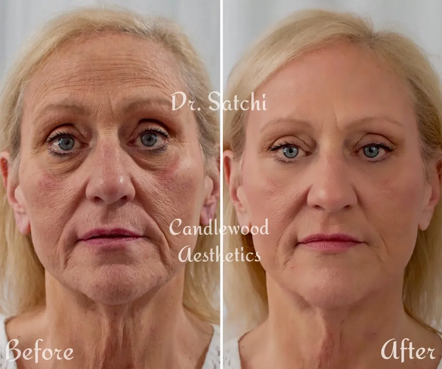 Side-by-side comparison of a woman's face before and after cosmetic treatment, showing improved skin texture and reduced wrinkles, with the before image on the left and after on the right.