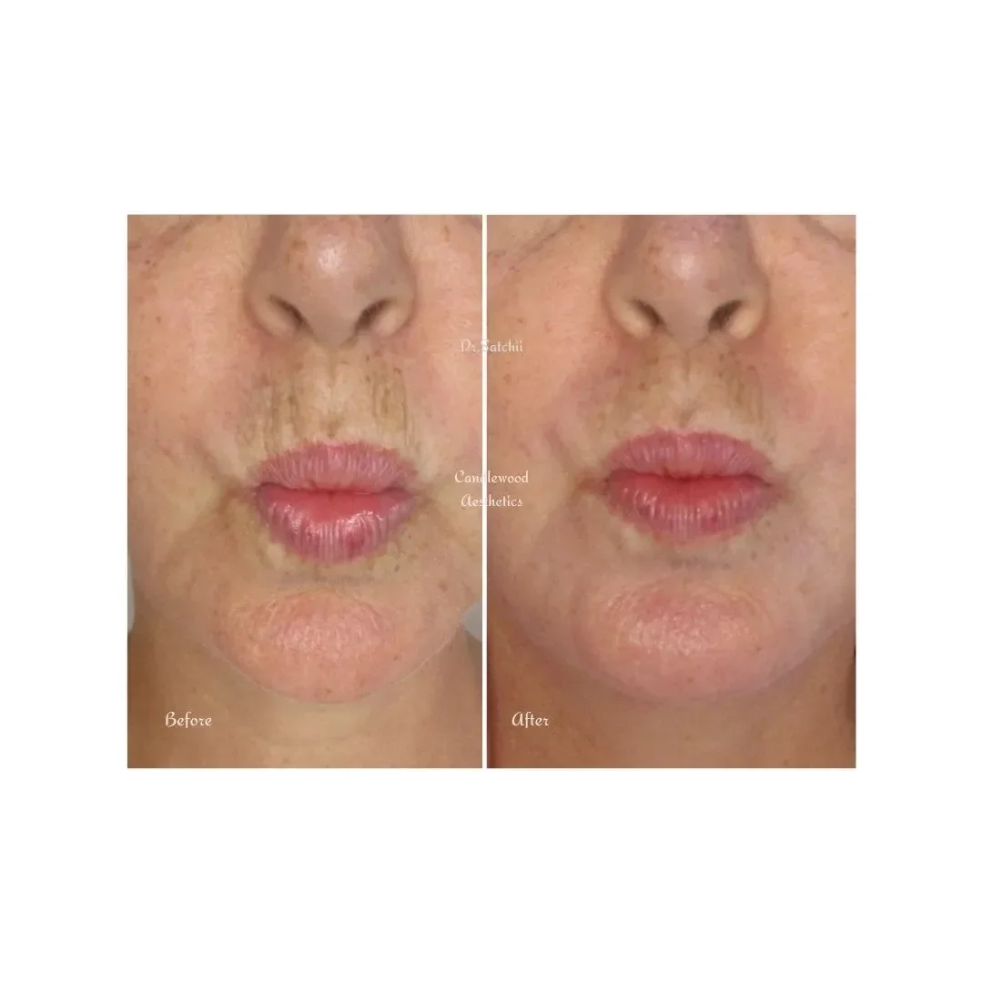 Side-by-side comparison of a woman's face showing before and after skincare treatment, focusing on reduced pigmentation and smoother skin.