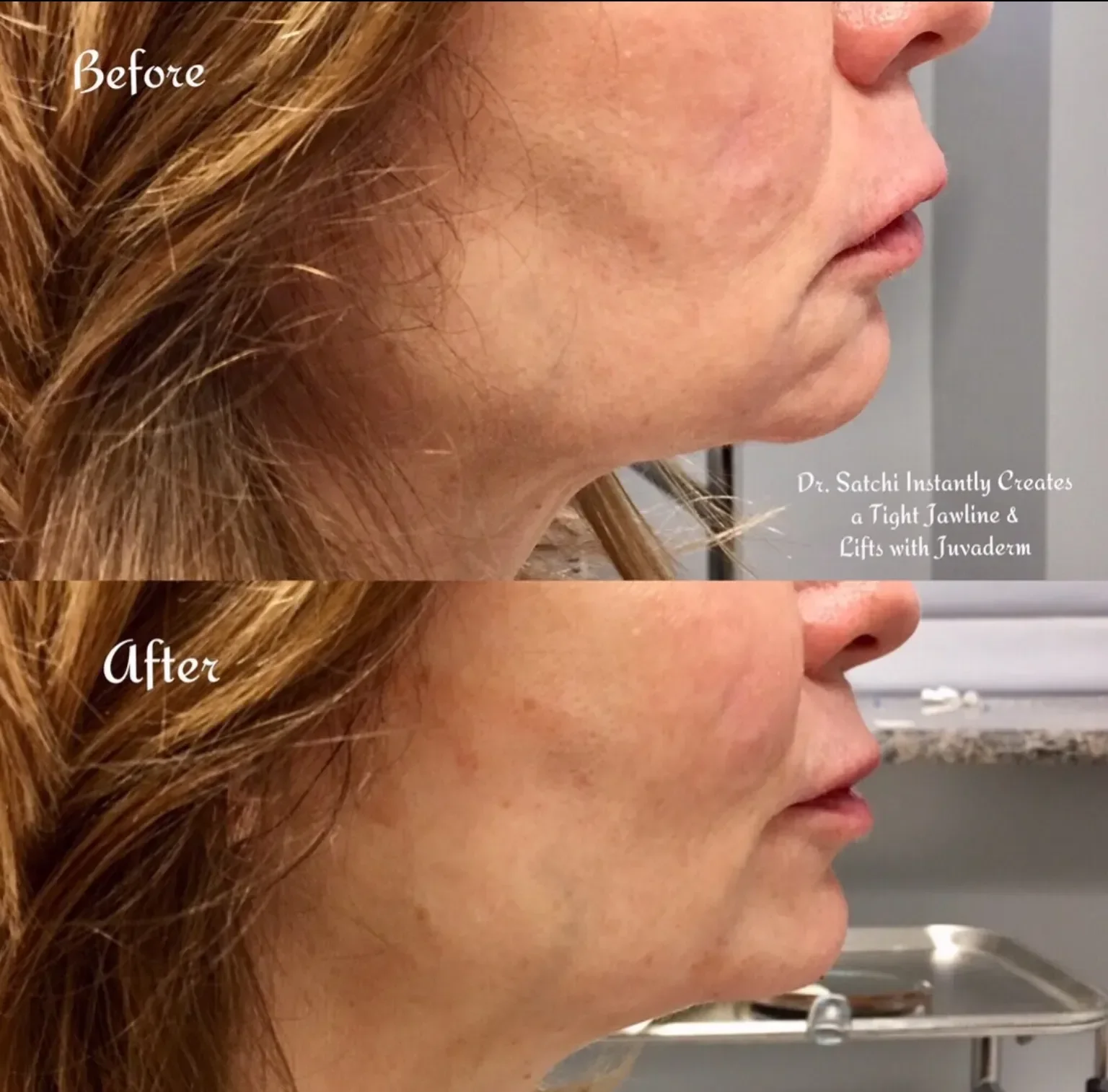 Side-by-side comparison of woman's jawline before and after medical treatment. The "before" image shows loose skin, while the "after" image shows tightened skin with improved definition.