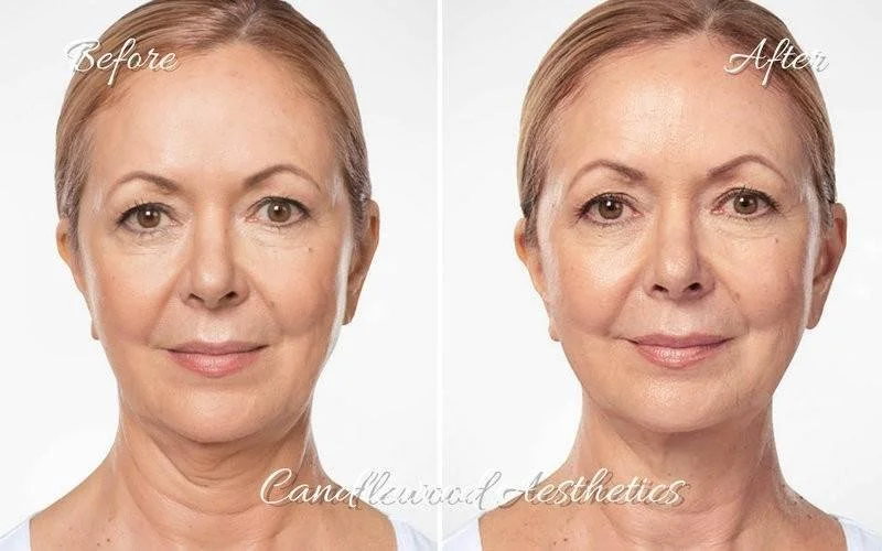 Side-by-side comparison of a woman's face showing before and after cosmetic treatment, with the 'before' on the left and 'after' on the right.