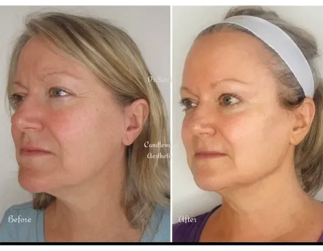 Side-by-side comparison of a woman before and after cosmetic treatment, showing improved skin smoothness and reduced wrinkles.