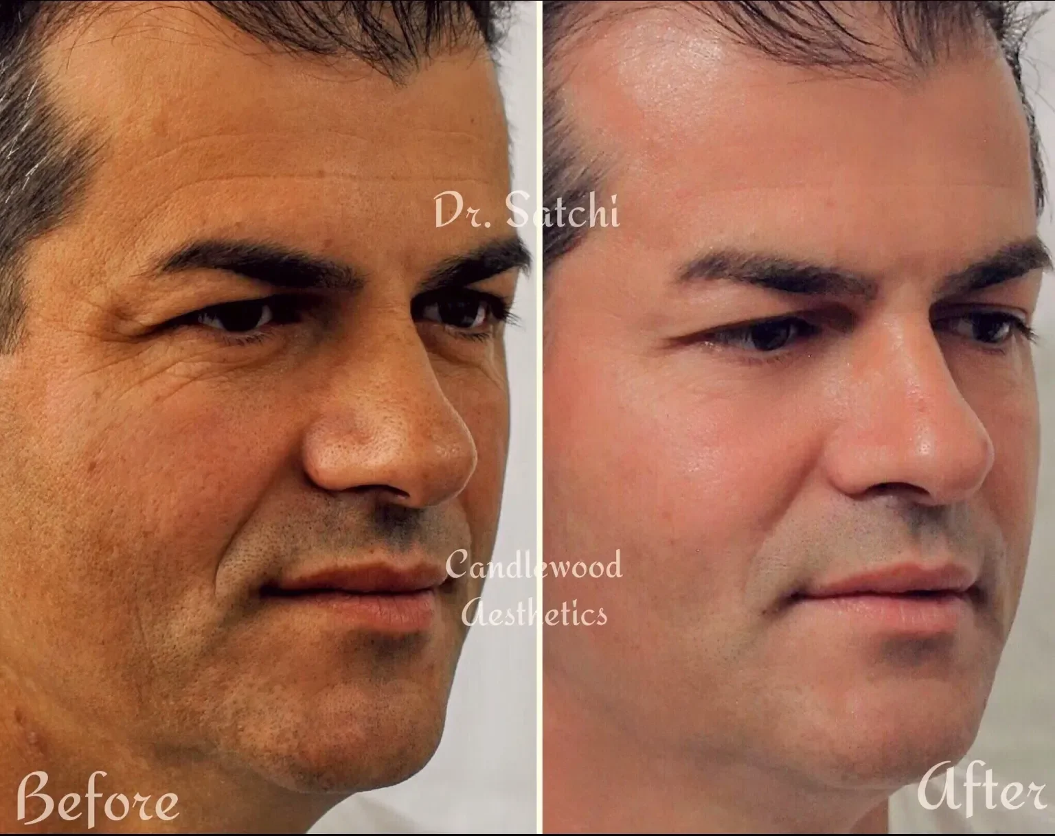 Side-by-side comparison of a man's face showing wrinkles and skin texture before and after cosmetic treatment, with clear improvements in skin smoothness and wrinkle reduction.