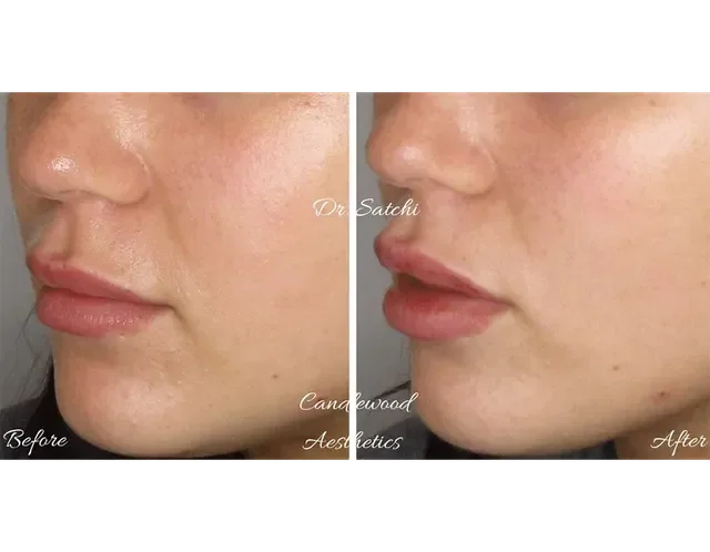 Comparison of a woman's lips and skin before and after cosmetic treatment, showing fuller lips and smoother skin in the after photo.