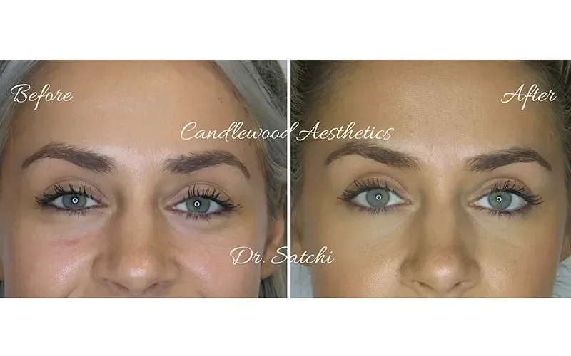 Side-by-side comparison of a woman's face showing the 'before' and 'after' results of cosmetic treatment, with the 'before' labeled on the left and the 'after' on the right, highlighting improvements in skin appearance and texture.